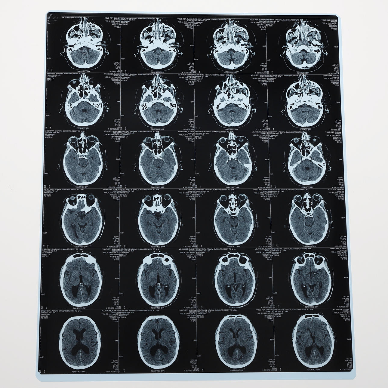 RÖNTGENPLÅT, plast, skottskada till huvud, 2007.